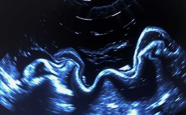what-is-echocardiogram
